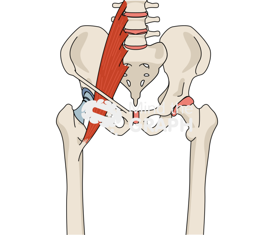 Iliopsoas impingement and total hip arthroplasty bone full Icons, Symbols, Pictures, and Images