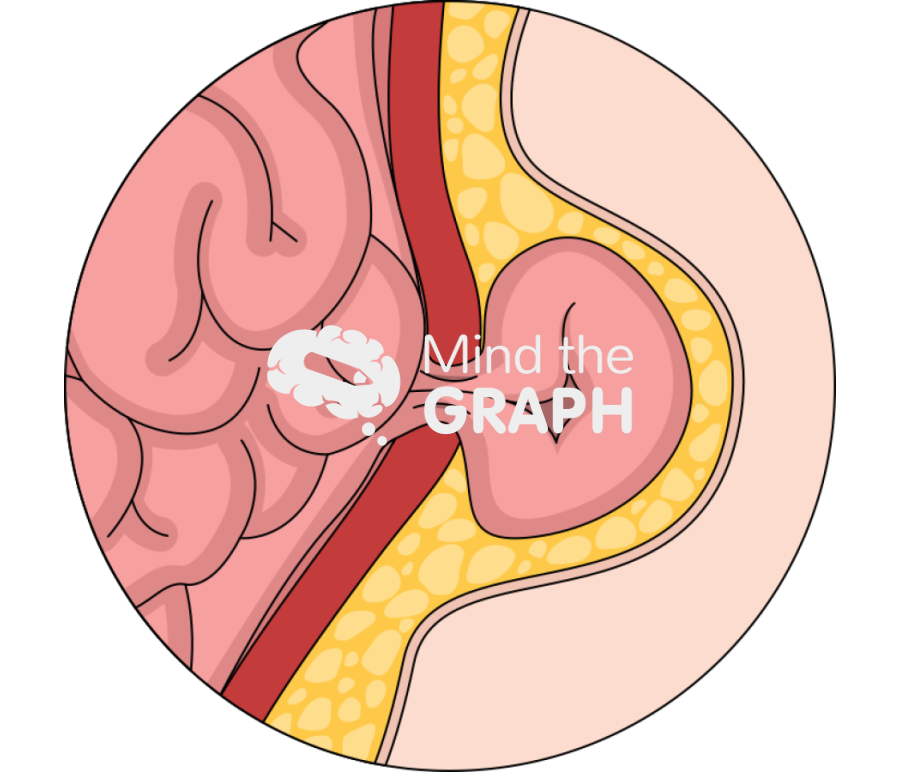 Abdominal ventral hernia Icons, Symbols, Pictures, and Images