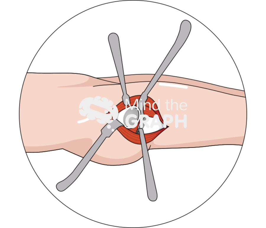 Acetabular exposure direct anterior approach zoom Icons, Symbols, Pictures, and Images