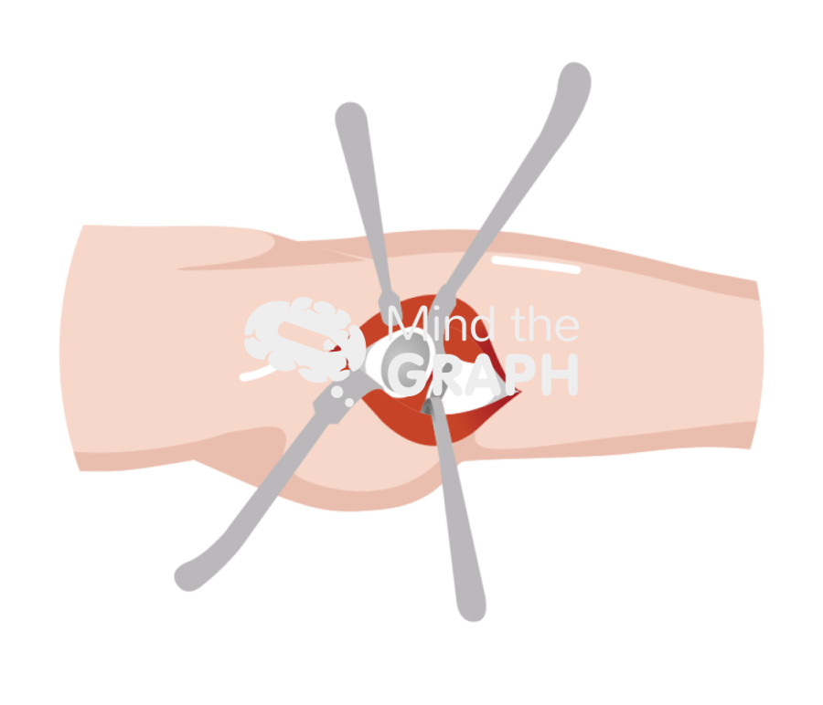 Acetabular exposure direct anterior approach zoom Icons, Symbols, Pictures, and Images