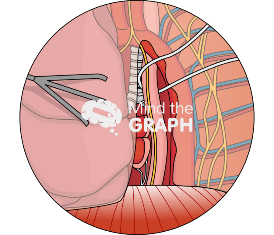 Achalasia open pleural zoom Icons, Symbols, Pictures, and Images