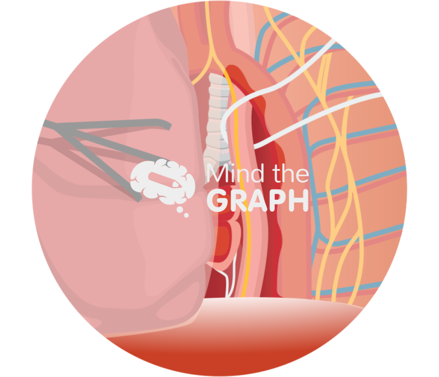 Achalasia open pleural zoom Icons, Symbols, Pictures, and Images