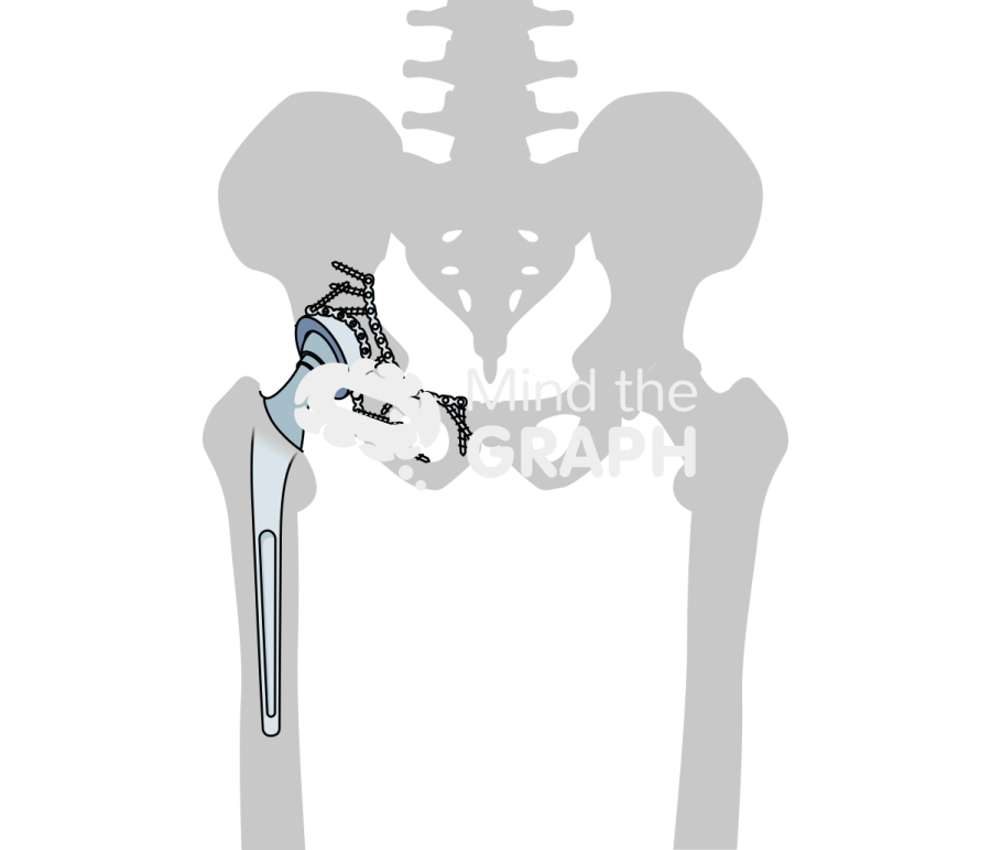 Acute acetabular fracture repair total hip arthroplasty bone Icons, Symbols, Pictures, and Images