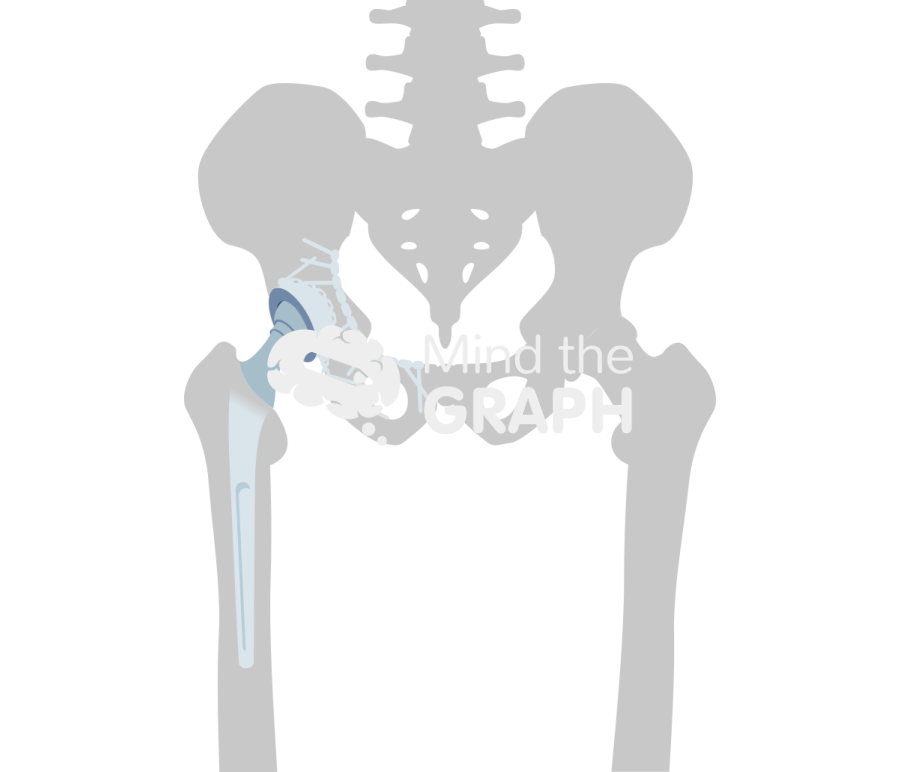 Acute acetabular fracture repair total hip arthroplasty bone Icons, Symbols, Pictures, and Images