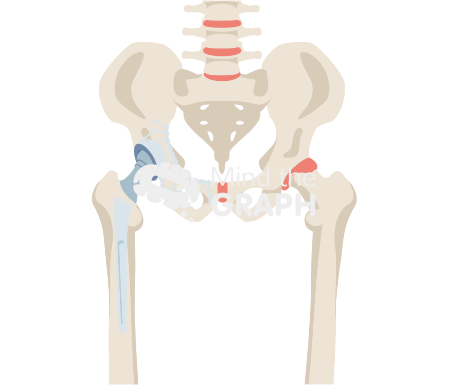 Acute acetabular fracture repair total hip arthroplasty bone full Icons, Symbols, Pictures, and Images