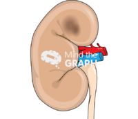 Acute kidney injury 3 - Edit and Customize Icons of Acute kidney injury 3 Acute kidney injury 3 Icons, Symbols, Pictures, and Images
