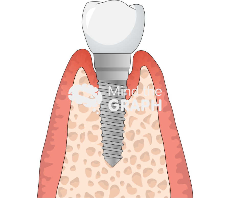 Advanced peri implantitis Icons, Symbols, Pictures, and Images