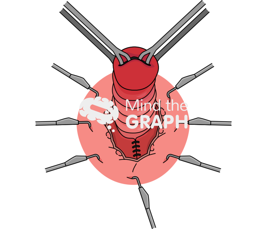 Altemeier procedure rectal prolapse Icons, Symbols, Pictures, and Images