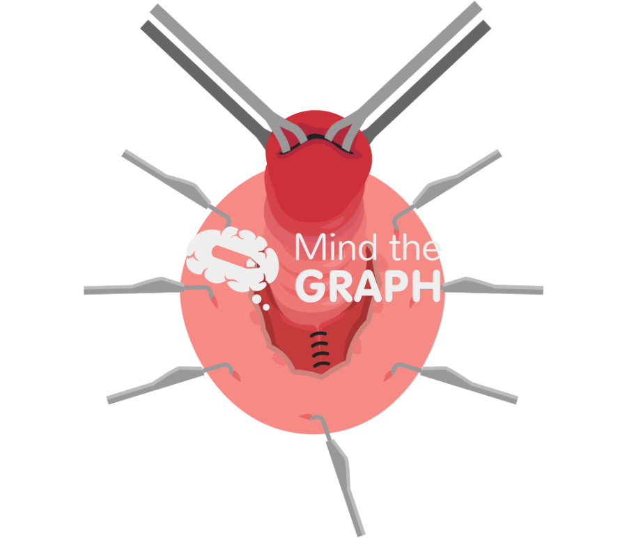 Altemeier procedure rectal prolapse Icons, Symbols, Pictures, and Images