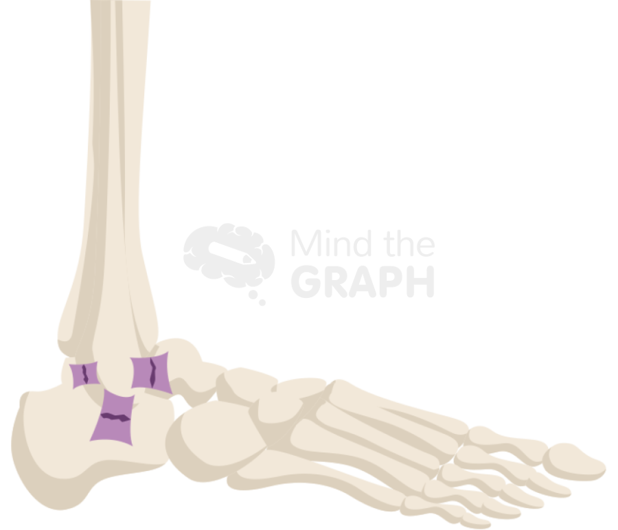 Ankle sprain lateral Icons, Symbols, Pictures, and Images