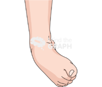 Ankle sprain severe front Icons, Symbols, Pictures, and Images