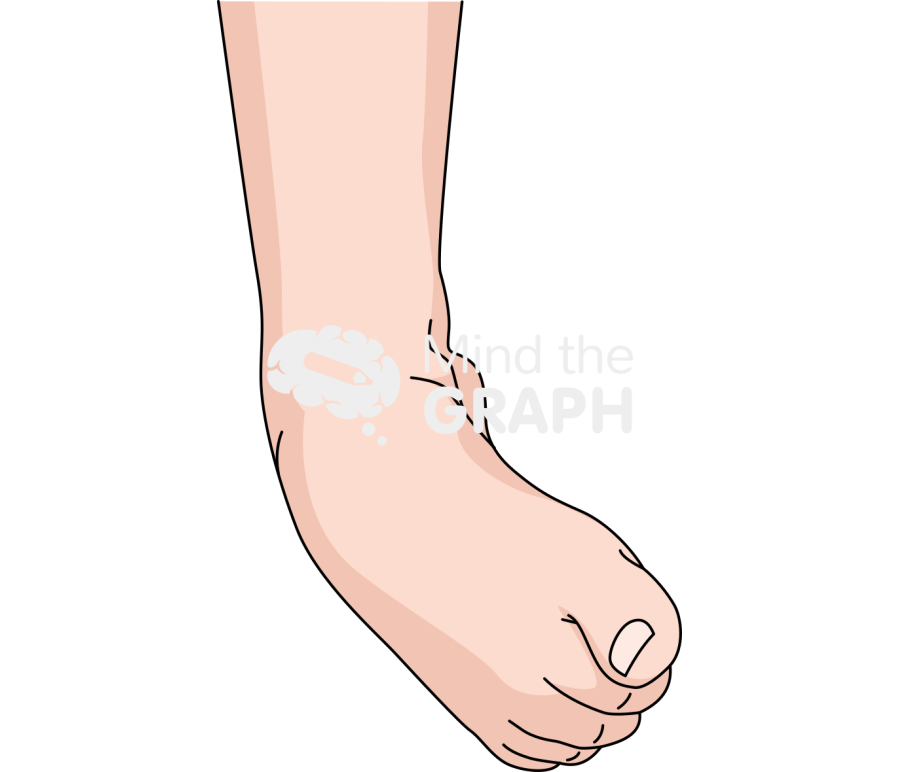 Ankle sprain severe front Icons, Symbols, Pictures, and Images