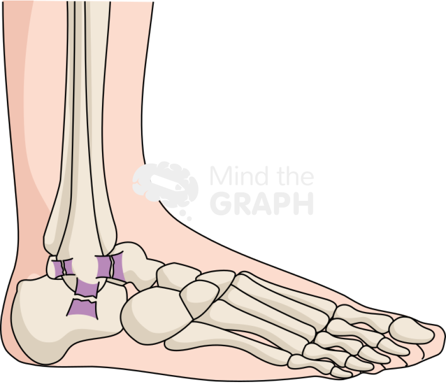 Ankle sprain severe lateral body full Icons, Symbols, Pictures, and Images