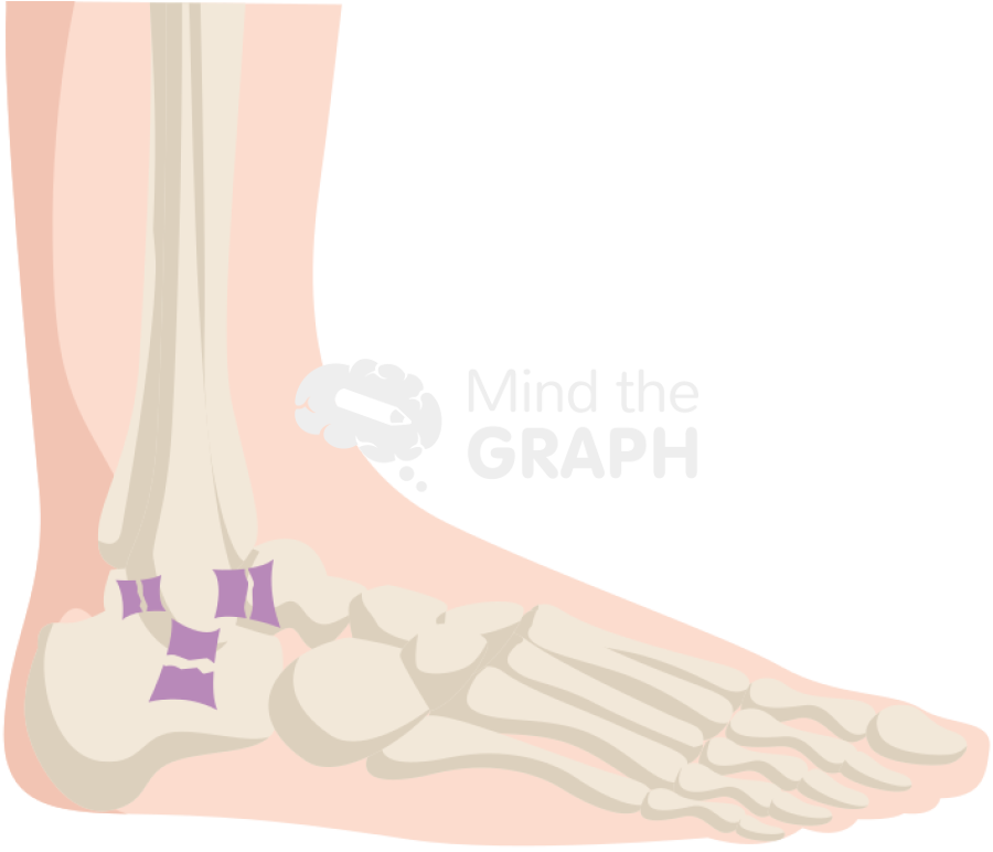 Ankle sprain severe lateral body full Icons, Symbols, Pictures, and Images