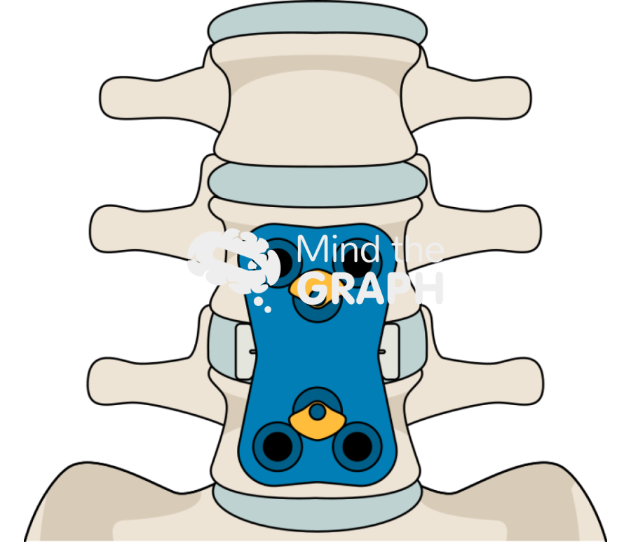 Anterior lumbar interbody fusion Icons, Symbols, Pictures, and Images