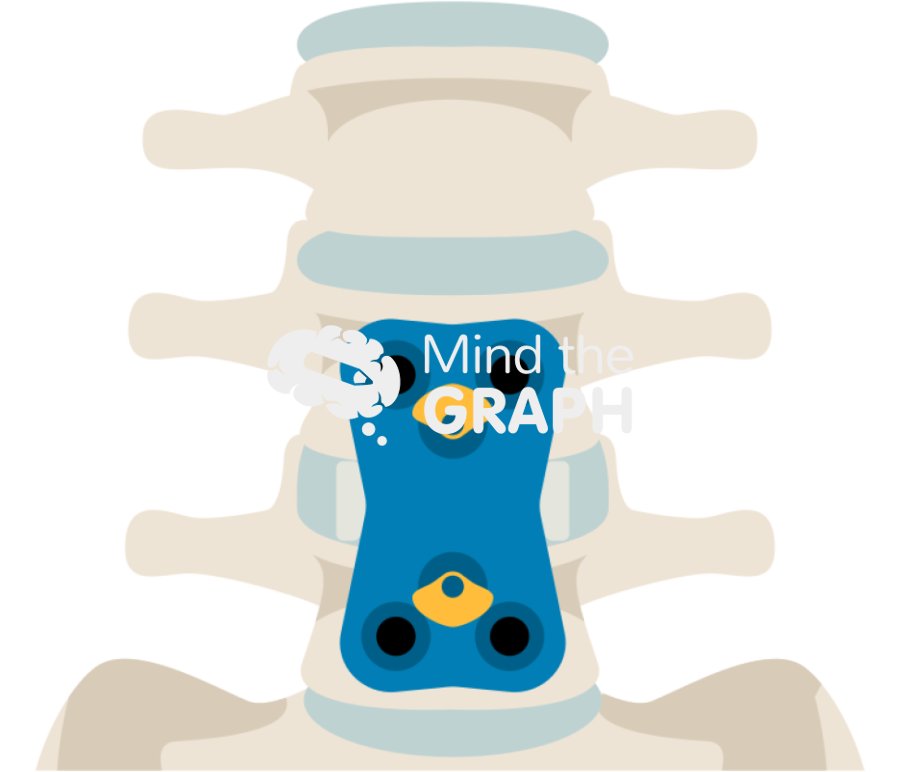 Anterior lumbar interbody fusion Icons, Symbols, Pictures, and Images