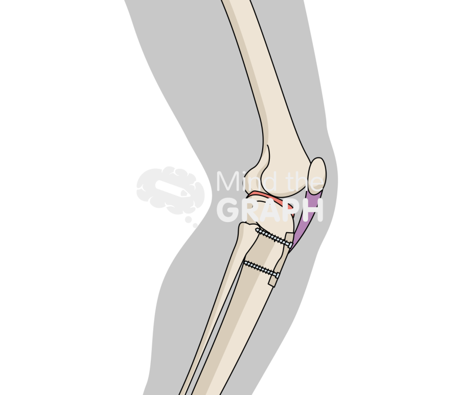 Anteromedialization patella body Icons, Symbols, Pictures, and Images