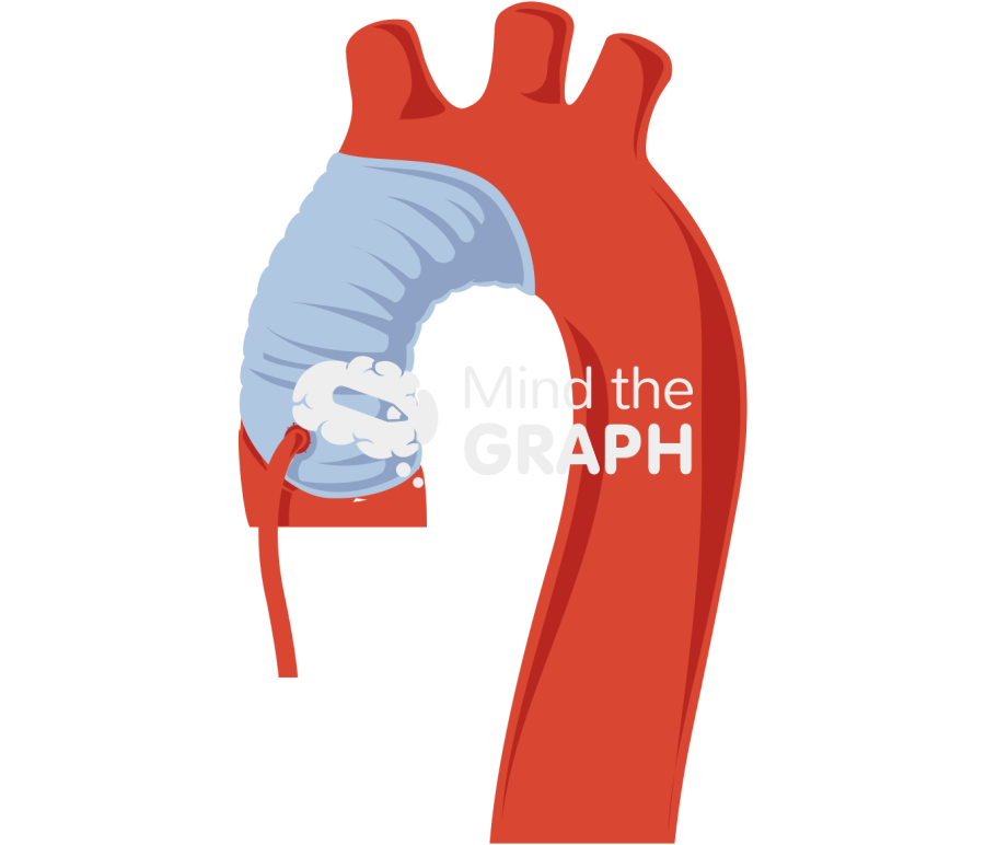 Aortic aneurysm 1 Icons, Symbols, Pictures, and Images