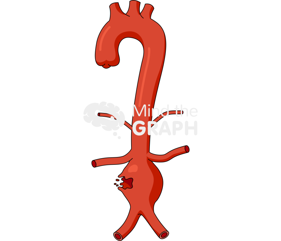 Aortic aneurysm rupture front Icons, Symbols, Pictures, and Images