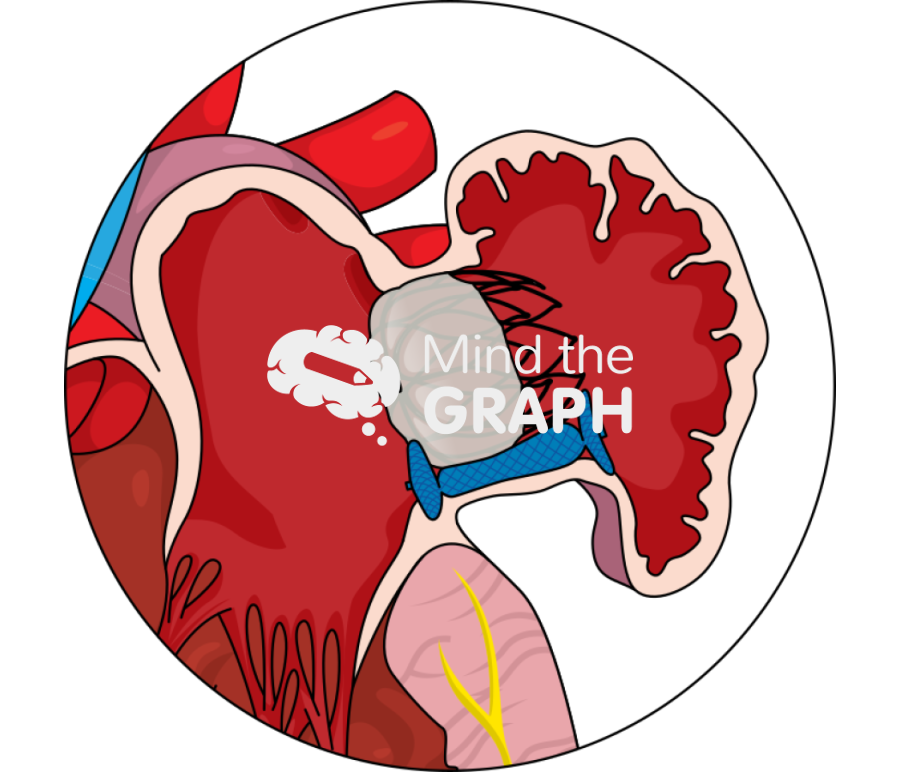 Appendage peri device leak closure zoom Icons, Symbols, Pictures, and Images