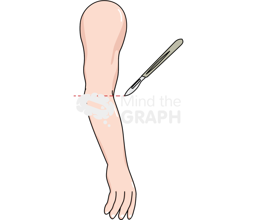 Arm amputation lateral Icons, Symbols, Pictures, and Images