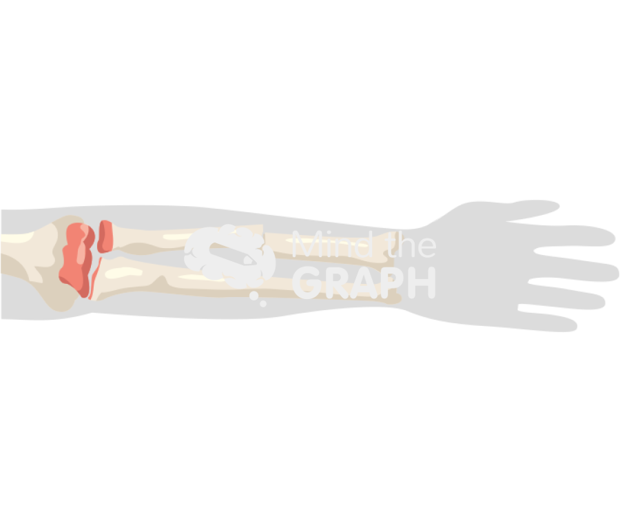 Arm closed fracture change color Icons, Symbols, Pictures, and Images
