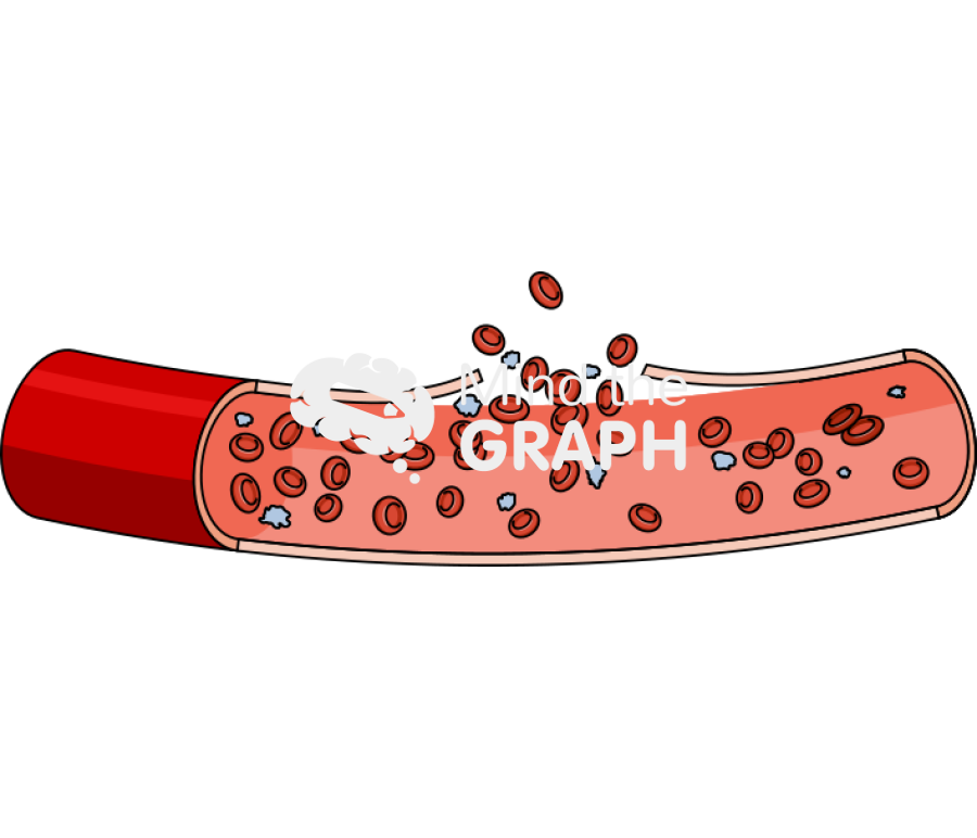 Artery blood clot 1 longitudinal cut Icons, Symbols, Pictures, and Images