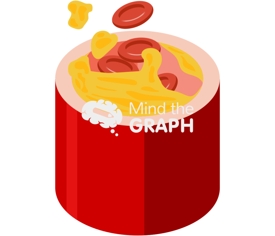 Artery plaque emboli breaking off Icons, Symbols, Pictures, and Images