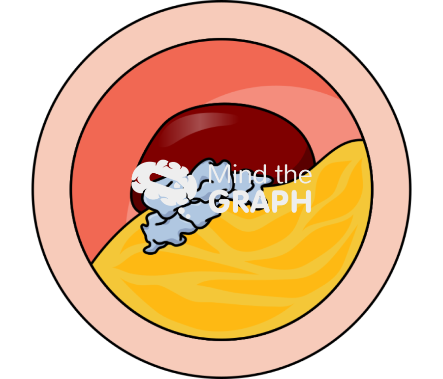 Artery plaque nstemi transversal cut Icons, Symbols, Pictures, and Images