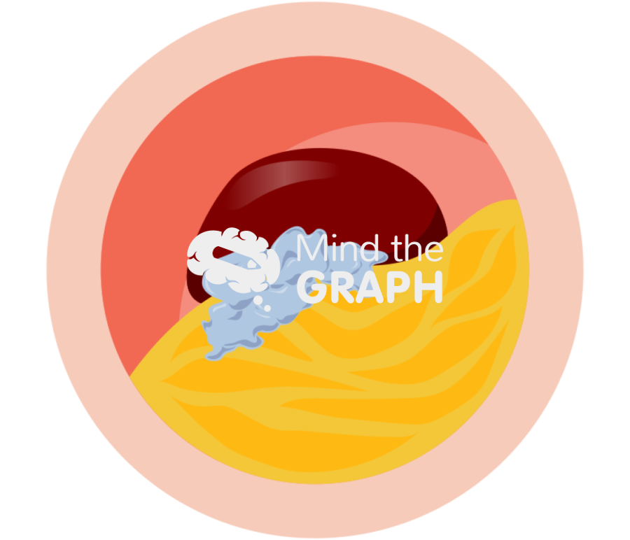 Artery plaque nstemi transversal cut Icons, Symbols, Pictures, and Images