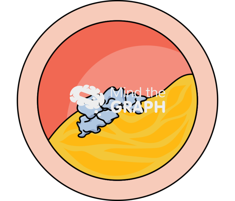 Artery unstable plaque angina transversal cut Icons, Symbols, Pictures, and Images