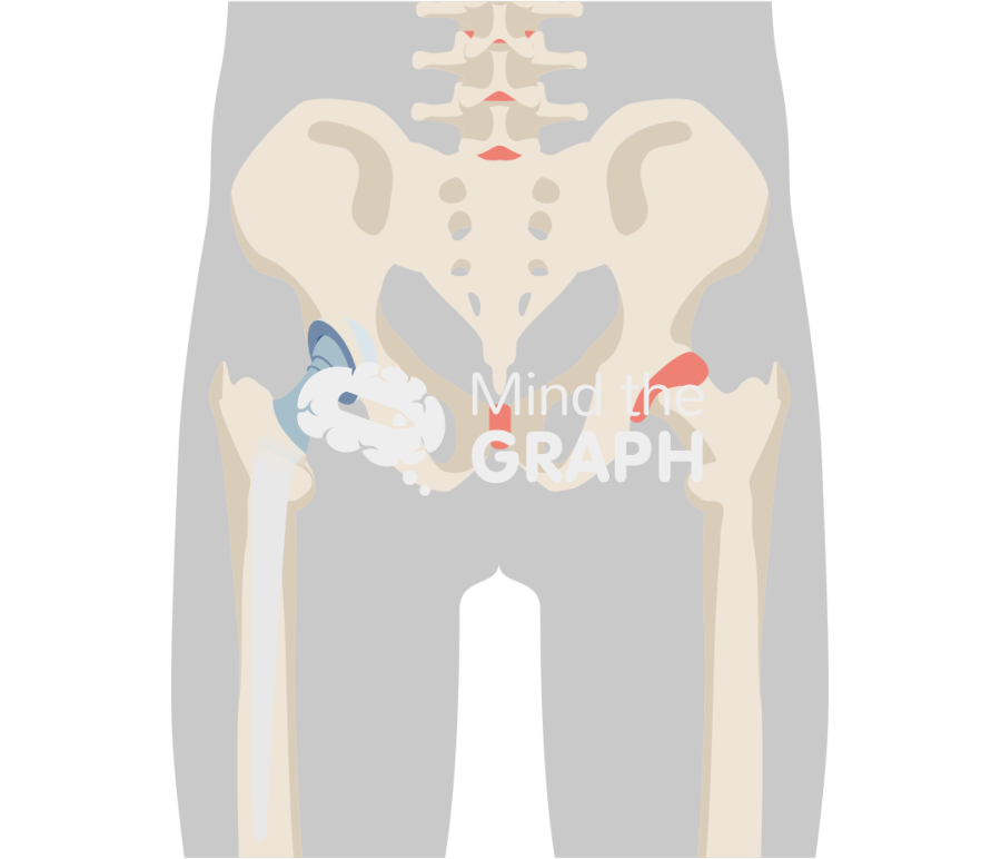 Articulating abx spacer anteroposterior hip body Icons, Symbols, Pictures, and Images