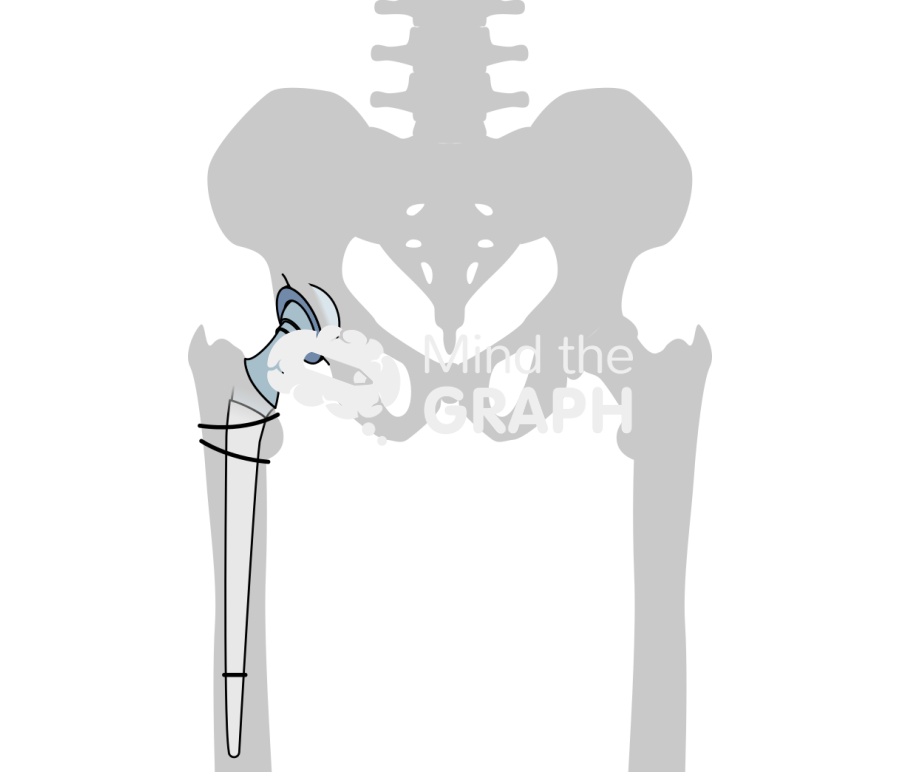 Articulating abx spacer anteroposterior hip bone Icons, Symbols, Pictures, and Images