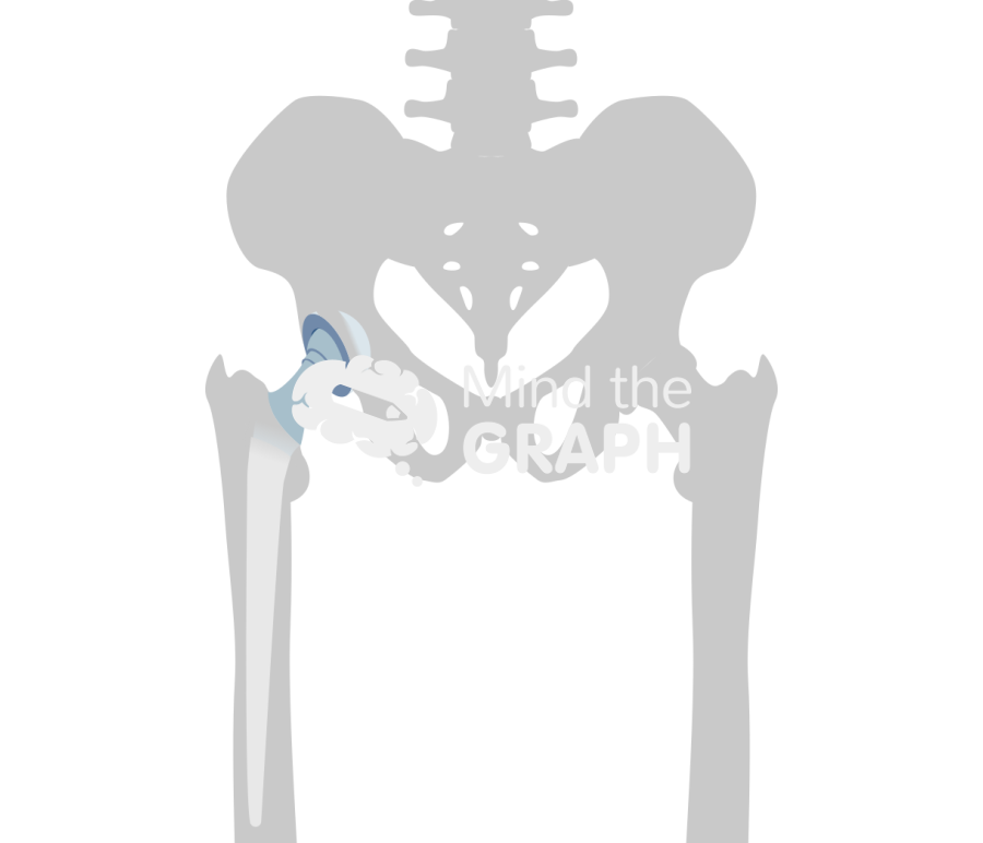 Articulating abx spacer anteroposterior hip bone Icons, Symbols, Pictures, and Images