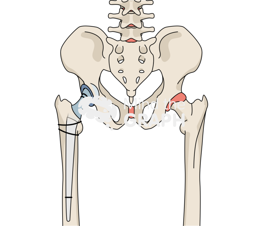 Articulating abx spacer anteroposterior hip bone full Icons, Symbols, Pictures, and Images