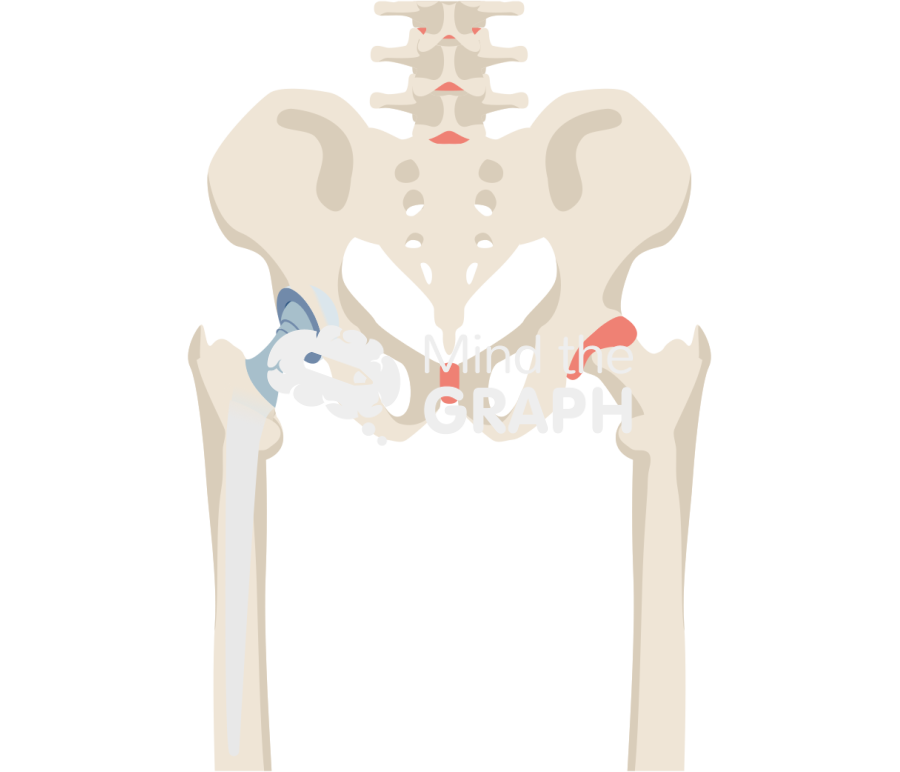 Articulating abx spacer anteroposterior hip bone full Icons, Symbols, Pictures, and Images