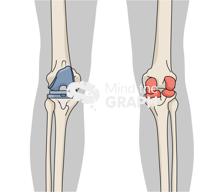 Articulating spacer anteroposterior knee body Icons, Symbols, Pictures, and Images