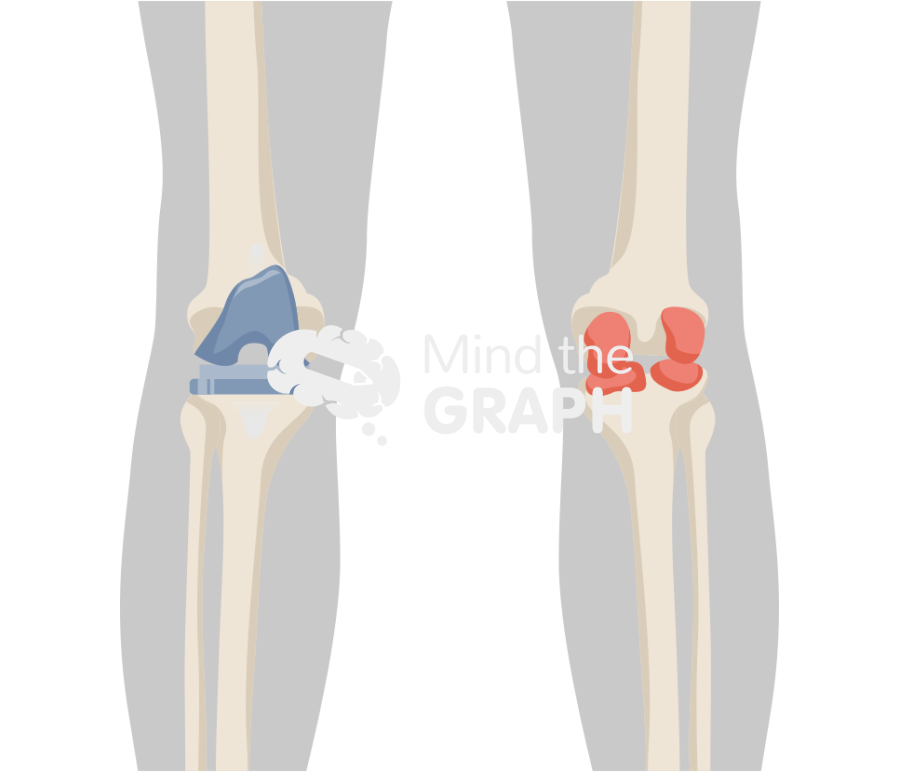 Articulating spacer anteroposterior knee body Icons, Symbols, Pictures, and Images