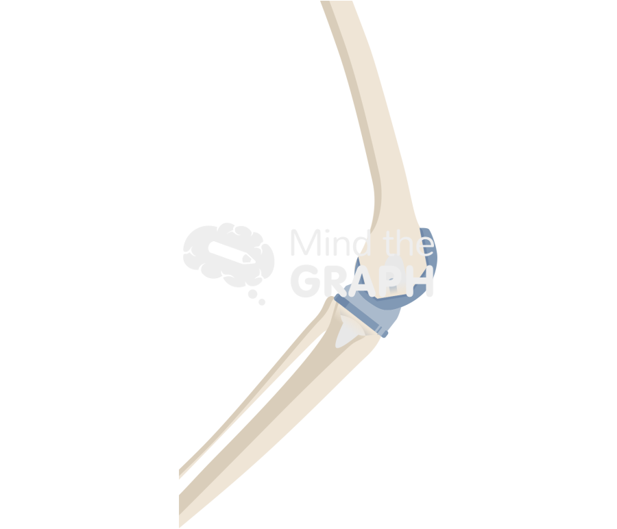 Articulating spacer lateral knee bone full Icons, Symbols, Pictures, and Images