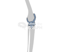 Aseptic loosening total knee arthroplasty bone Icons, Symbols, Pictures, and Images