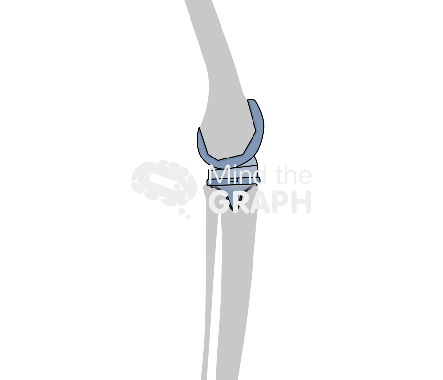 Aseptic loosening total knee arthroplasty bone Icons, Symbols, Pictures, and Images