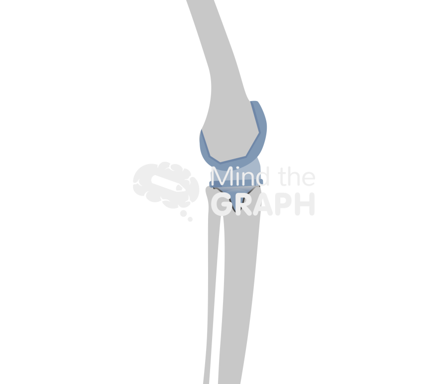 Aseptic loosening total knee arthroplasty bone Icons, Symbols, Pictures, and Images