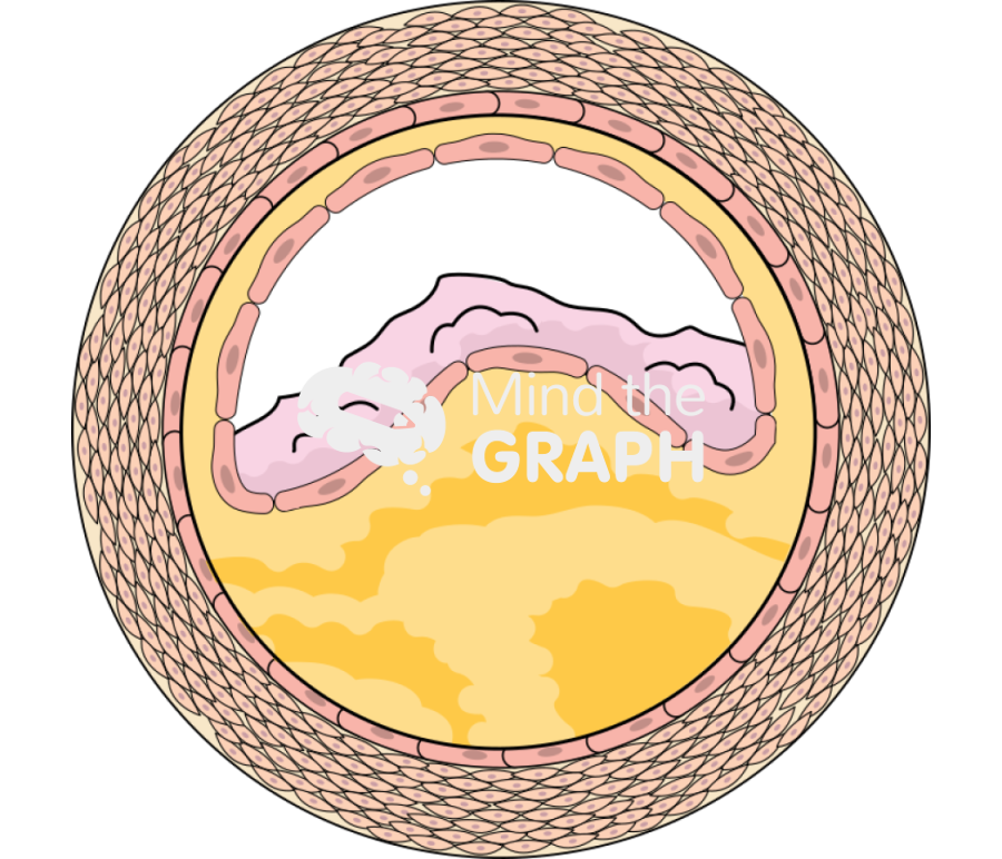 Free Atheroma 4 Icons, Symbols, Pictures, and Images | Mind the Graph