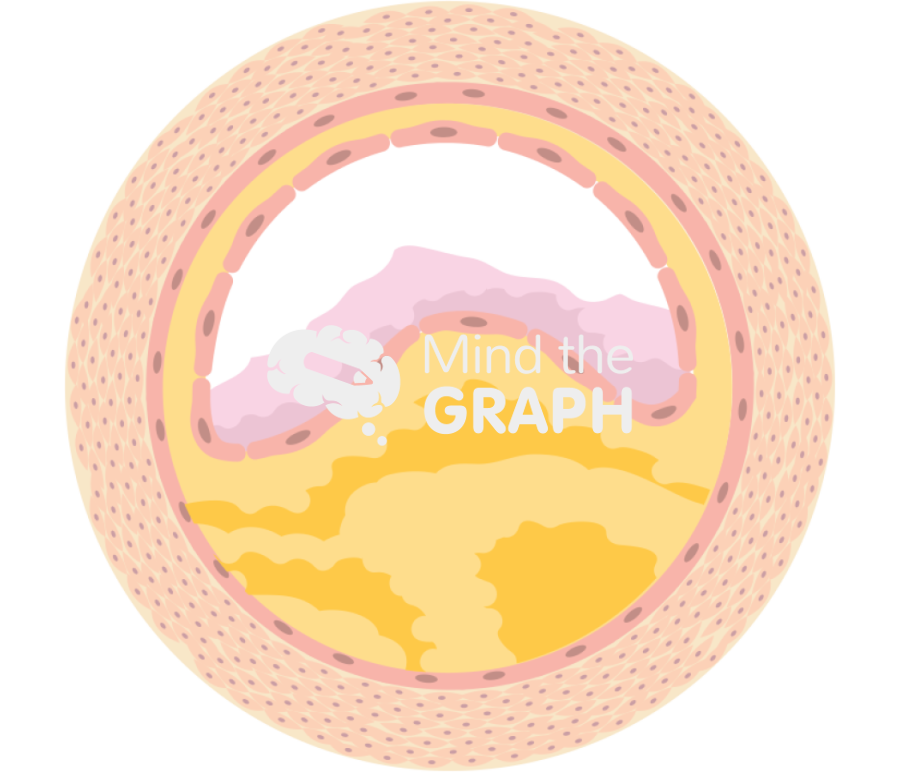Atheroma 4 Icons, Symbols, Pictures, and Images