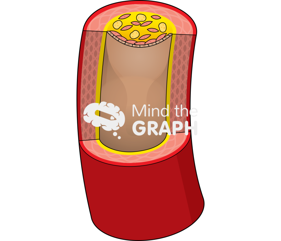 Atherosclerosis plaque Icons, Symbols, Pictures, and Images