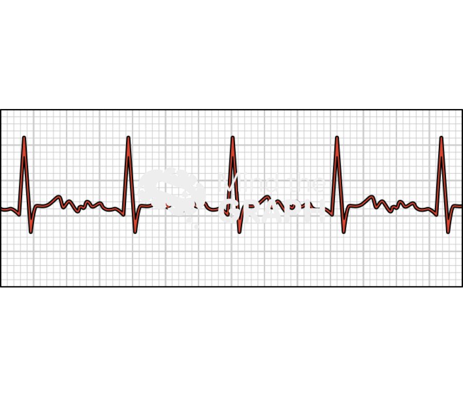 Atrial fibrilation electrocardiogram Icons, Symbols, Pictures, and Images