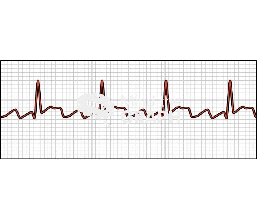 Atrial flutter electrocardiogram Icons, Symbols, Pictures, and Images