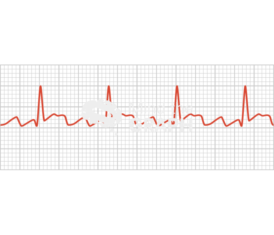 Atrial flutter electrocardiogram Icons, Symbols, Pictures, and Images