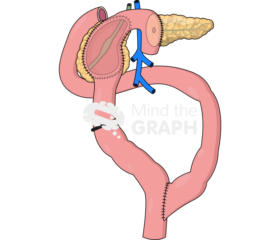 Beger procedure Icons, Symbols, Pictures, and Images