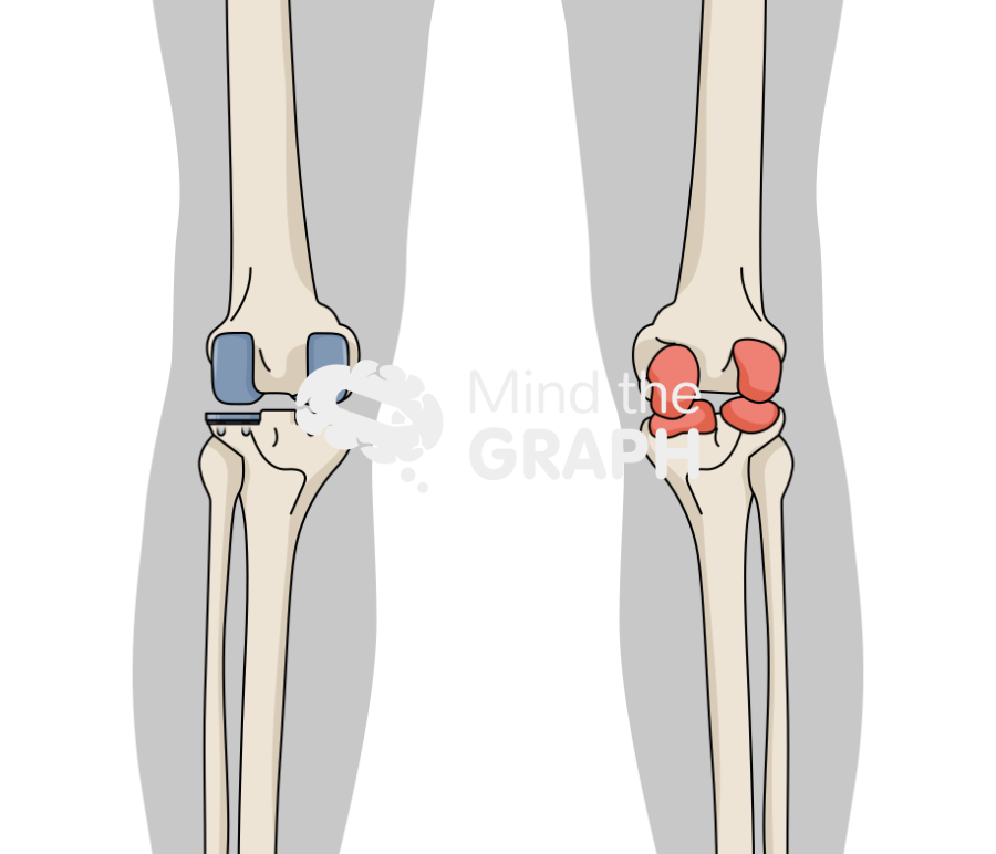 Bicondylar knee arthroplasty anterior posterior body Icons, Symbols, Pictures, and Images